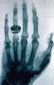 【世界上第一张x光片】 发现x射线后,伦琴用这种射线拍摄了他夫人的